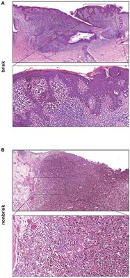 Immune Cell Infiltration of the Primary Tumor, Not PD-L1 Status, Is Associated With Improved Response to Checkpoint Inhibition in Metastatic Melanoma